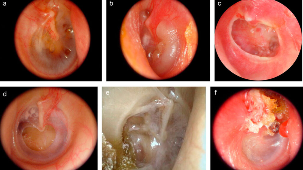 Otitis media crónica